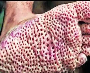 رهاب النخاريب